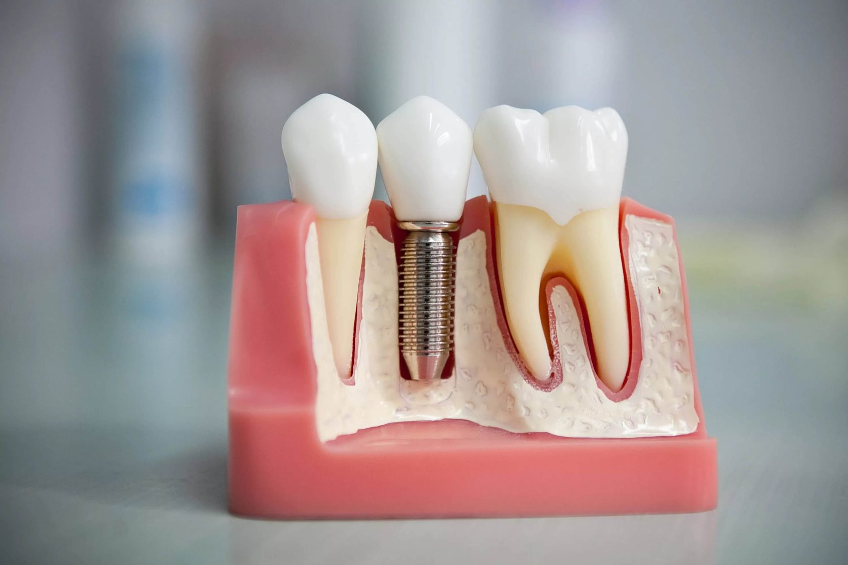 имплантация зубов в митино